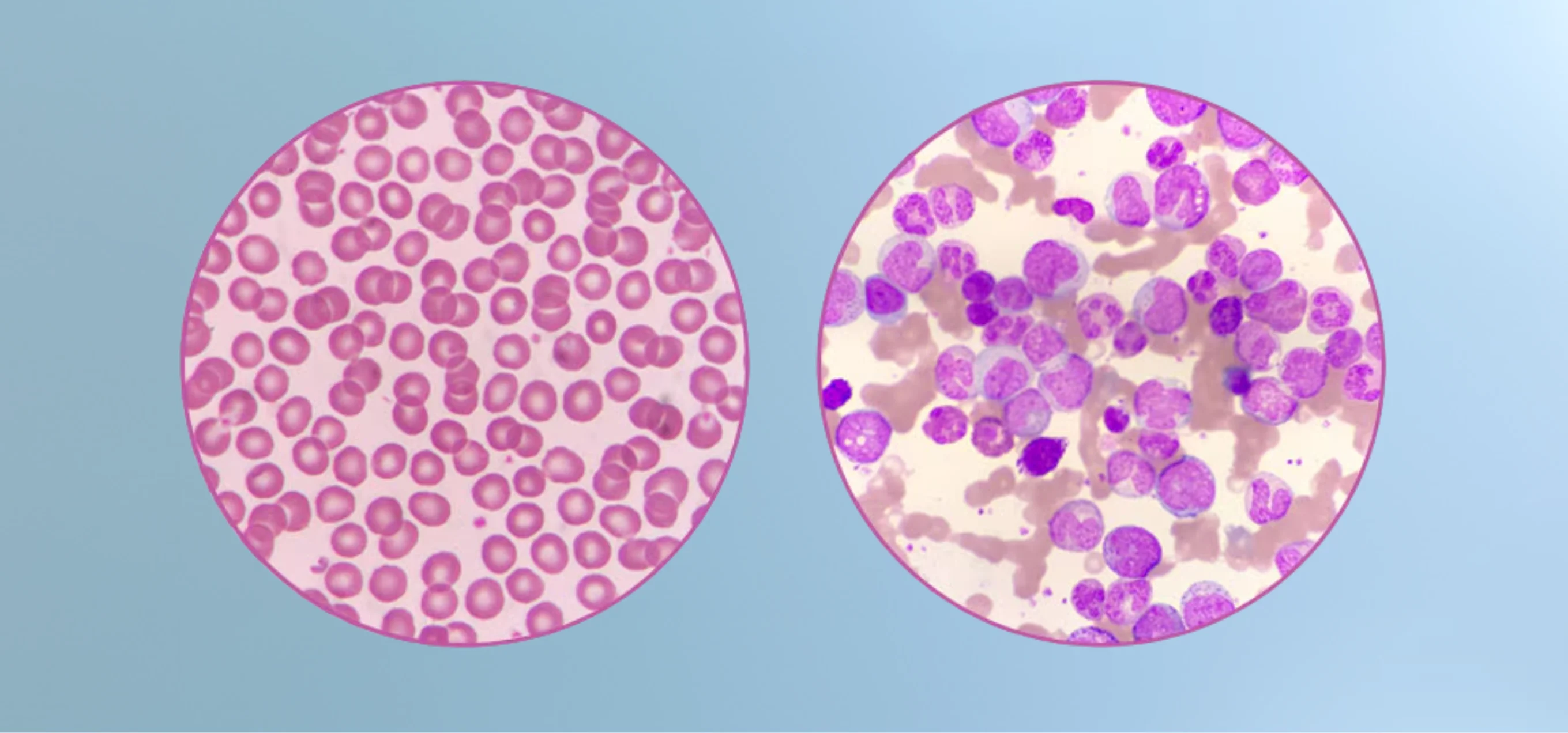 Leukemia treatment by Dr. G. Stitha Pragna, Hemato-Oncologist in Hyderabad